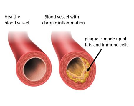 chronic inflammation